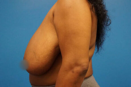 Breast Reduction case #3462