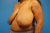 Breast Reduction case #3462