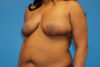 Breast Reduction case #3462