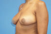 Breast Reduction case #3386