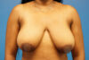 Breast Reduction case #3471