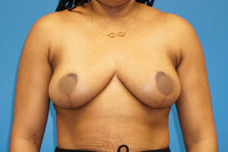 Breast Reduction case #3471