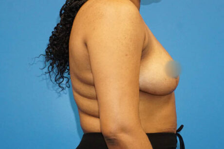 Breast Reduction case #3471