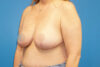 Breast Reduction case #3482