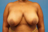 Breast Reduction case #3493