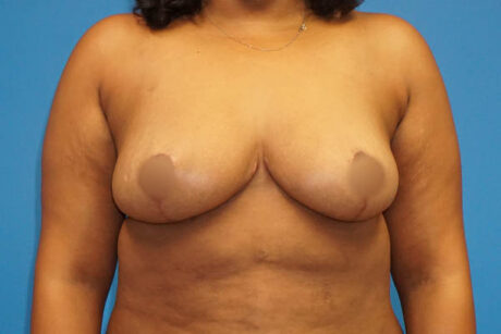 Breast Reduction case #3493