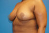 Breast Reduction case #3493