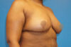 Breast Reduction case #3493