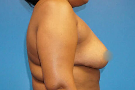 Breast Reduction case #3493