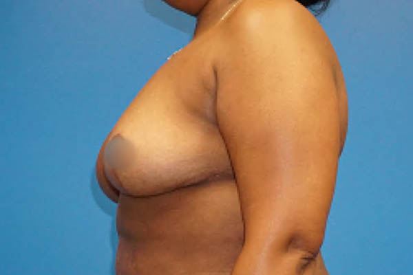 Breast Reduction case #3493