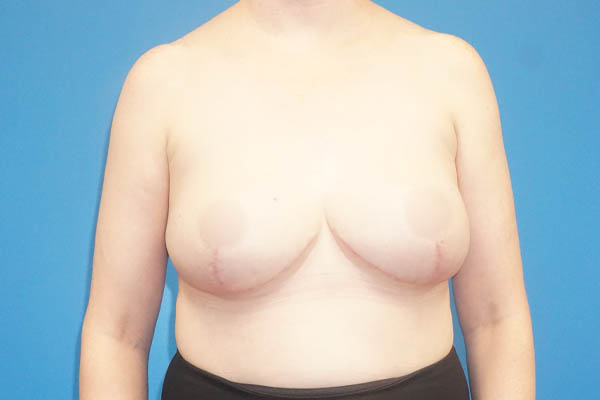 Breast Reduction case #3504