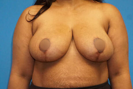 Breast Reduction case #3515