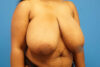 Breast Reduction case #3515