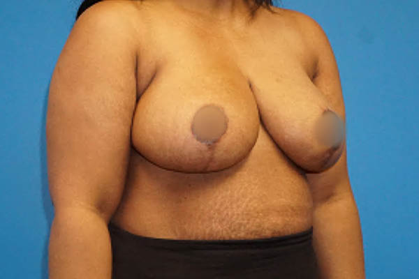 Breast Reduction case #3515