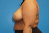 Breast Reduction case #3515