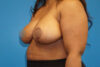 Breast Reduction case #3515