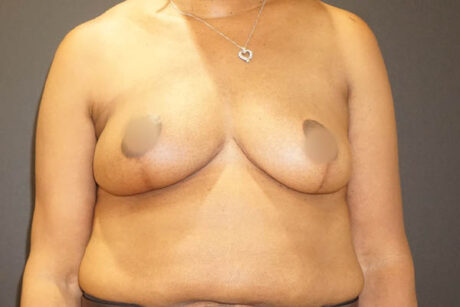 Breast Reduction case #3526