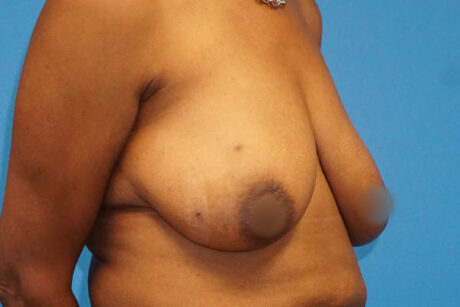 Breast Reduction case #3526