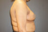 Breast Reduction case #3526