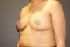 Breast Reduction case #3526