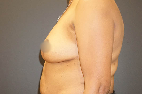 Breast Reduction case #3526