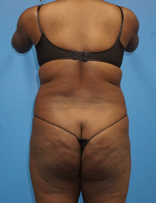 Liposuction case #3790