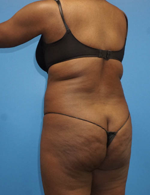 Liposuction case #3790