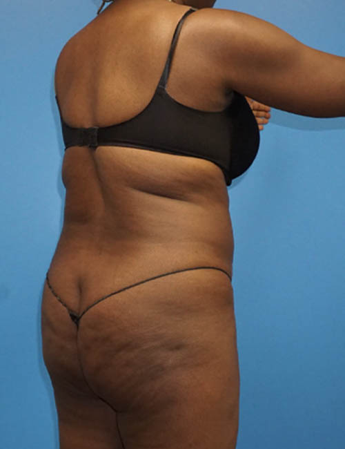 Liposuction case #3790