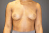 Breast Augmentation case #3816