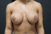 Breast Augmentation case #3816