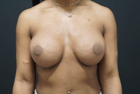 Breast Augmentation case #3816