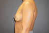 Breast Augmentation case #3816