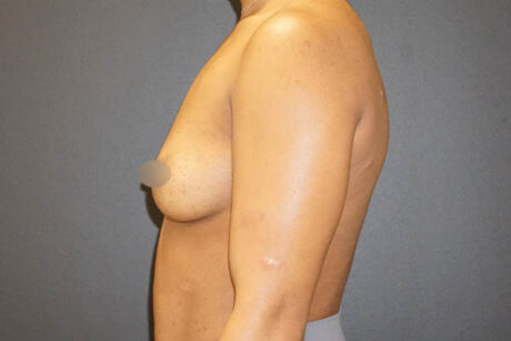 Breast Augmentation case #3816