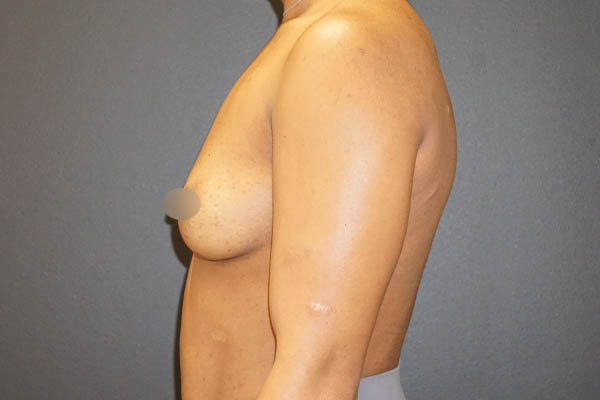 Breast Augmentation case #3816