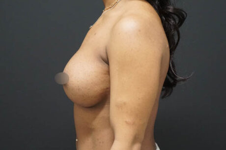 Breast Augmentation case #3816