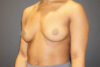 Breast Augmentation case #3816