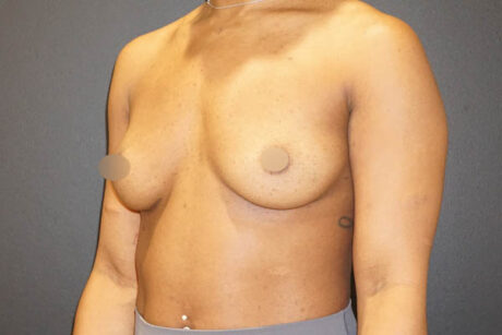 Breast Augmentation case #3816