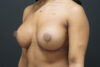 Breast Augmentation case #3816