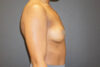 Breast Augmentation case #3816