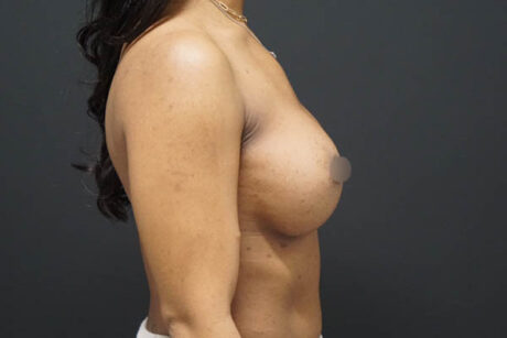 Breast Augmentation case #3816