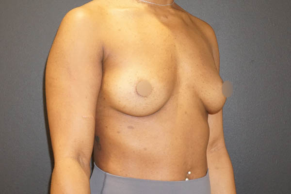 Breast Augmentation case #3816