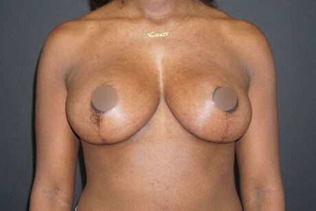 Breast Lift case #3827