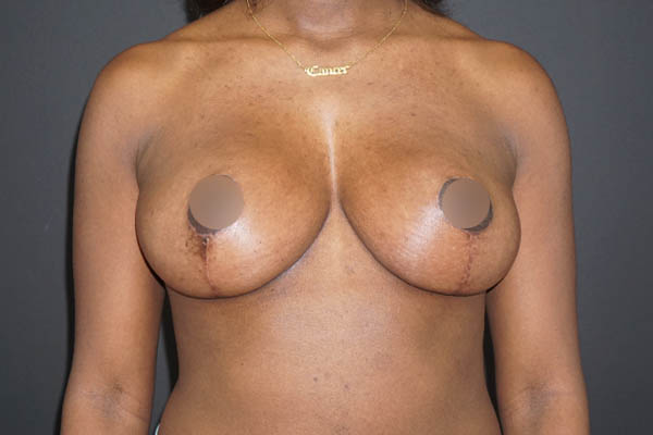 Breast Lift case #3827