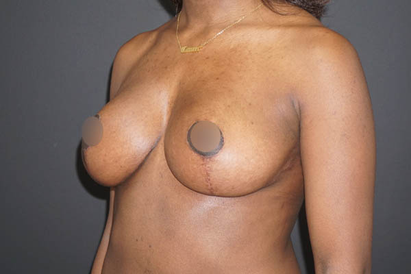 Breast Lift case #3827