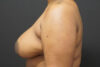 Breast Reduction case #3960