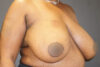 Breast Reduction case #3918