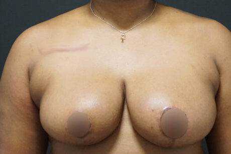 Breast Reduction case #3960