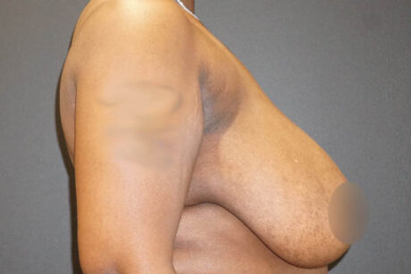 Breast Reduction case #3918