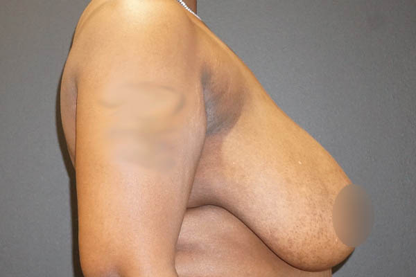 Breast Reduction case #3918