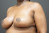 Breast Reduction case #3918